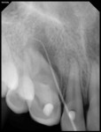 Fig 2. Tracer radiographic examination revealed the origin of gutta-percha in the apical end of an invagination with respect to tooth No. 7.