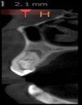 Fig 3. In CBCT, sagittal (Fig 3) and transverse (Fig 4) sections revealed that the main canal was located palatally and an invaginated, C-shaped (C), enamel-lined canal interconnected with the periodontal ligament space labially in the apical area and was associated with periapical lesion and perforated (P) labial cortical plate. A thin channel (TC) was present between the main canal and the C-shaped invaginatus.