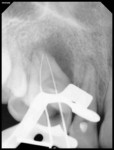 Fig 6. Working length radiograph was taken.