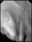 Fig 8. Follow-up at 12 months showed resolution of sinus tract and complete healing of periapical radiolucency.