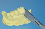 Fig 1. The clinical crown was cut with a scalpel at the gingival margins of a VPS cast.