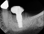 Fig 7. Radiograph at time of implant placement showing implant, grafted defect, and customized healing abutment, which contained and protected the graft material.