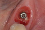 Fig 9. Four months post placement, residual bone grafting material could be seen in the soft tissue.