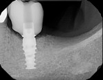 Fig 11. Radiograph at time of definitive crown placement showing ideal emergence contours.