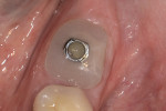 Fig 8. After 6 weeks of healing there was favorable adaptation of gingival tissues to the cutomized healing abutment.