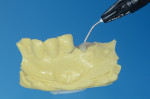 Fig 4. The well was filled with a flowable composite resin, and four wings 2 mm to 3 mm in length covered the gingival outline.