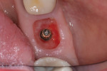 Fig 15. Six weeks post placement, ideal soft-tissue contours were evident, and the implant was well integrated.