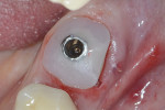 Fig 6. A temporary titanium cylinder was attached to the rootform shell; after graft placement, the customized healing abutment was placed.