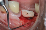Fig 13. Upon finishing, the healing abutment was placed and the tissues sutured.