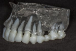 Fig 2. STL model fabricated from the CBCT data, with teeth in an opaque resin and bone in transparent resin to allow differentiation between the structures.