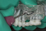 Fig 5. Acrylic bur used to create the lateral window into the sinus following the outline created on the STL model.