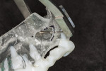 Fig 11. A Castroviejo caliper may be used to determine bone thickness on the lateral aspect of the maxilla to allow the surgeon to know how deep osseous cuts will be made before encountering the sinus membrane.