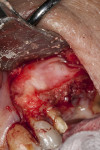 Fig 17. Osseous graft material packed into the sinus under the elevated membrane and window covered with PRF.