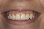 Fig 1. Preoperative smile with 4 mm to 5 mm of gingival display.