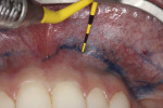 Fig 2. Incision design made with a vertical extension 8 mm to 10 mm apical to the inferior border located at the mucogingival junction.