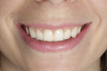 Fig 12. Smile at 1-year follow-up.