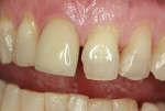 Figure 4  Fractured central incisor requiring an all-porcelain crown.