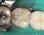 Figure 8  Defective posterior composite on a second molar.
