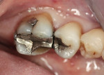 Figure 11  A mandibular first molar with a fractured mesial lingual cusp.