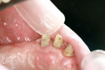 Figure 18  Dimple placed in a composite build-up of the cuspid.
