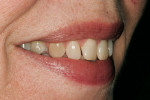 Figure 1  Preoperative right lateral view of the patient’s smile.