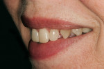 Figure 2  Preoperative left lateral view of the patient’s smile.