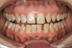 Figure 3  Preoperative retracted facial view. Note the positioning of tooth No. 10. This eliminated the possibility of treating the patient with no-prep veneers, as the patient was unwilling to first undergo orthodontics.