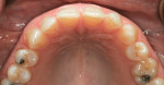 Figure 4  Close-up preoperative occlusal view of the maxillary arch. Note the rotation and buccal position of tooth No. 10, as well as the bucco-lingual position difference between teeth No. 8 and No. 9.