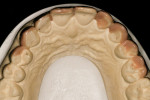 Figure 6  Only the distal half of tooth No. 9 and the facial of tooth No. 10 required reduction.
