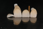 Fig 1. Ceramill Zolid HT+ crowns and a GC LiSi press lithium disilicate veneer; the crowns are on stump shade dies, to fine-adjust with stain
and glaze.