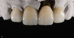 Fig 2. Crowns and a veneer placed on a master
cast and finished.