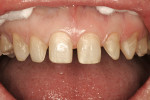 Figure 7  The teeth were minimally prepared, and the preparation depth was evaluated using a silicone matrix from the diagnostic wax-up, as well as by consulting the additive-reductive wax-up to locate areas needing more reduction.