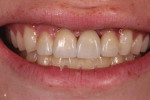 Fig 4. The seated case on the day of insertion, with the color blending in beautifully with the neighboring dentition.