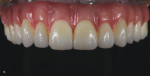 Fig 5. A full-contour, full-arch hybrid restoration using Ceramill Zolid HT+ after stain and glaze is finished. Porcelain is utilized for the pink areas.