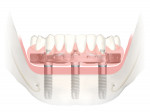 Fig 1. Using a premanufactured bar with a
unique fixation mechanism, the Trefoil system can adjust to compensate for inherent deviations from the ideal implant position and offer a high-quality definitive fixed solution in one day.