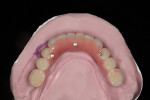 Fig 9. Conventional wax-up and processing for a wrap-around hybrid acrylic/titanium fixed prosthesis.