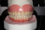 Fig 10. Final prosthesis. Existing maxillary denture is adjusted for an ideal occlusal scheme.
