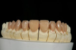 Figure 9  As a result of the resistance to grinding displayed by lithium disilicate, the cutback for incisal effects is done in the wax prior to investing and pressing.