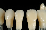 Figure 10  After firing the incisal effect, all restorations were placed on composite dies to evaluate the influence of the underlying color and distribution of incisal effects.