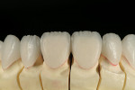 Figure 13  View of the pressed restorations prior to incisal effects layering. Usually only the central and lateral incisors are layered for detailed incisal effects. All other restorations are left non-layered to maximize strength.