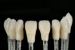 Figure 14  The lithium-disilicate restorations are placed on composite dies, and shading is applied to achieve the desired color prior to layering.