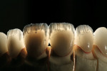 Figure 15  Backlighting of the incisal effect build-up shows the varying opacities of the fluorapatite layering powders that were used.