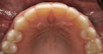 Figure 17  Postoperative occlusal view of the maxillary arch after cementation of the definitive restorations.