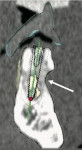 Figure 14c  Cross-sectional image (Nobel-Procera) of planning of implant placement.Note the differences in buccal-lingual contourand density of the distracted bone.