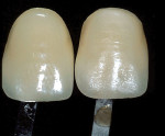 Figure 3  Image of two of the same shade guides with different surface texture. Notice the one with different texture is perceived as a different color.