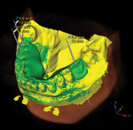 Digital planning using SmartFusion™ in the NobelClinician software. The digital rendering
of the desired final tooth position (ie, digital wax-up) is displayed in green, and the current tissue position (ie, model) is displayed in yellow.
