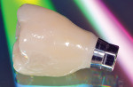 NobelProcera Full-Contour Zirconia Implant Crown.