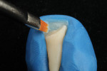 A thin layer of an enamel shade is placed using a silicone matrix fabricated from a mock-up of the restoration and cut back to the incisal edge. This first increment will act as a container to hold the subsequent layers of dentin that will form the inside of the restoration.
