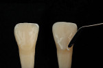 After a thin primary layer of chromatic enamel is placed to match the base chroma of the tooth, a final value enamel layer is placed and sculpted.
