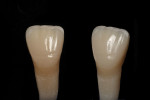 Polychromatic layering techniques enable practitioners to develop more natural esthetics that blend in seamlessly with the surrounding natural dentition.